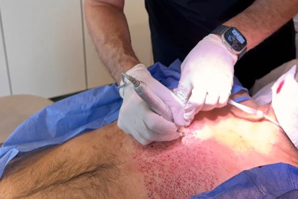 Body Hair Transplant