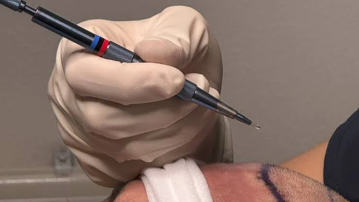 Hair Transplant For Male