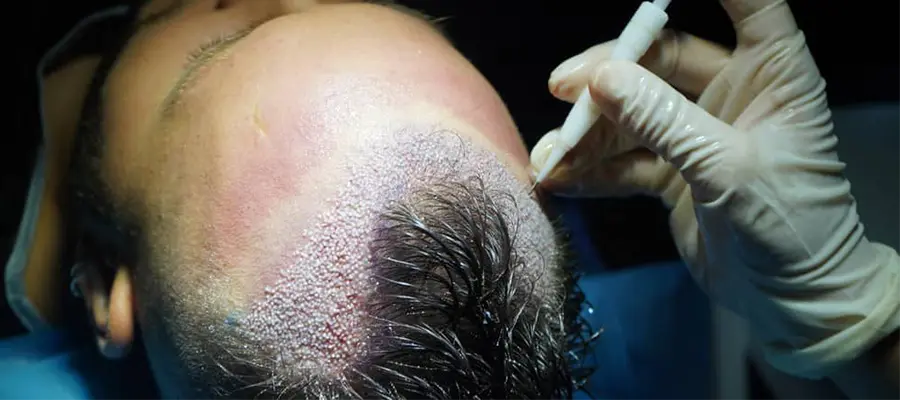 Unshaven Hair Transplant
